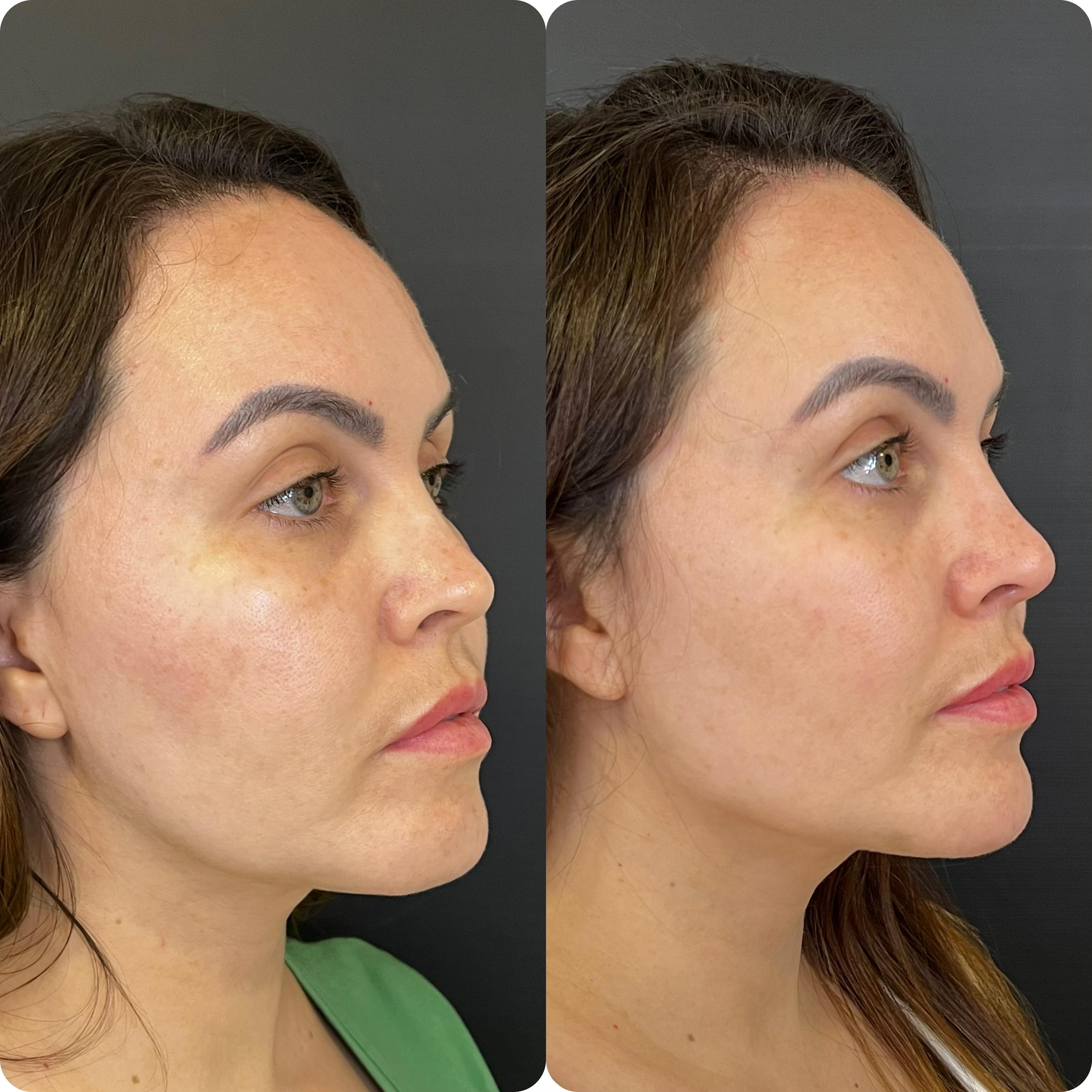 Harmonização Facial